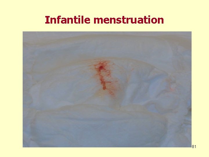 Infantile menstruation 81 