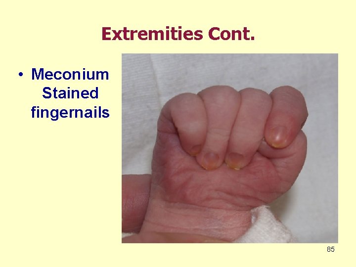Extremities Cont. • Meconium Stained fingernails 85 