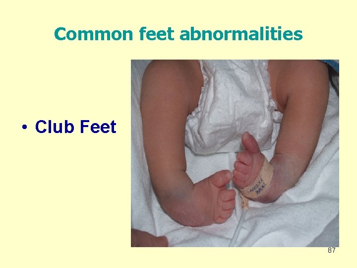 Common feet abnormalities • Club Feet 87 