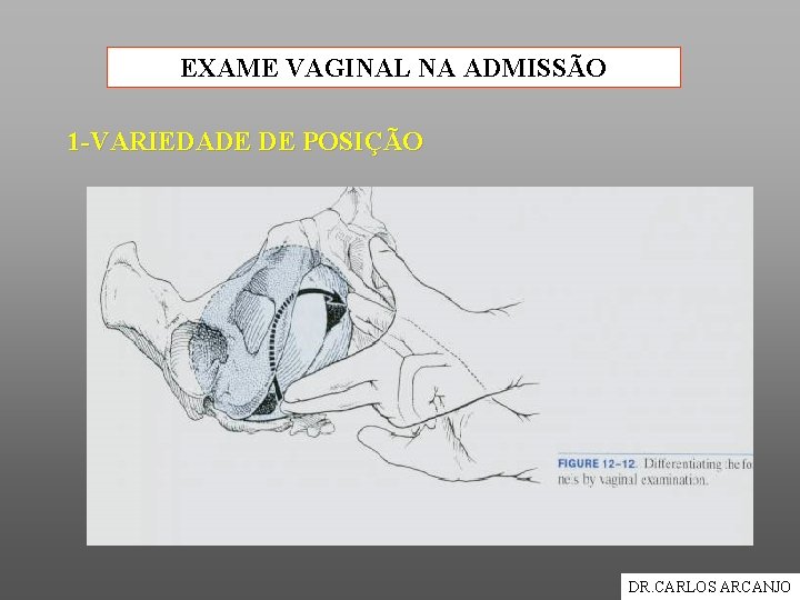 EXAME VAGINAL NA ADMISSÃO 1 -VARIEDADE DE POSIÇÃO DR. CARLOS ARCANJO 