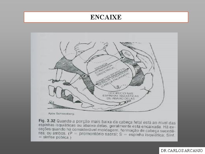 ENCAIXE DR. CARLOS ARCANJO 