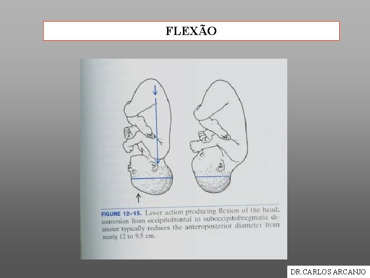 FLEXÃO DR. CARLOS ARCANJO 