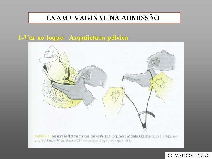 EXAME VAGINAL NA ADMISSÃO 1 -Ver no toque: Arquitetura pélvica DR. CARLOS ARCANJO 