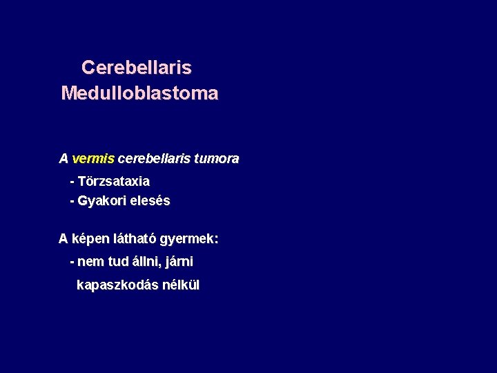 Cerebellaris Medulloblastoma A vermis cerebellaris tumora - Törzsataxia - Gyakori elesés A képen látható