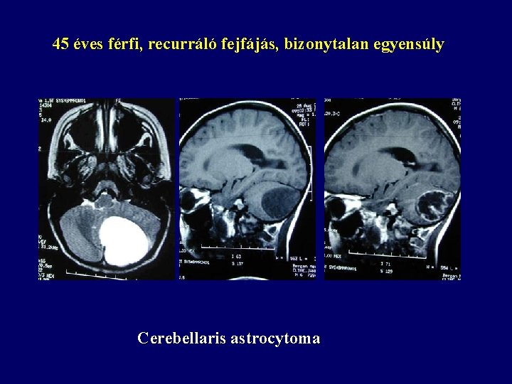 45 éves férfi, recurráló fejfájás, bizonytalan egyensúly Cerebellaris astrocytoma 