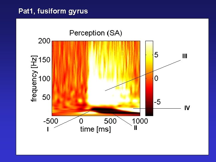 Pat 1, fusiform gyrus III IV I II 