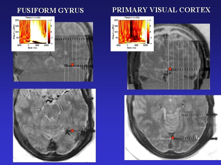 FUSIFORM GYRUS E’ PRIMARY VISUAL CORTEX O’ 