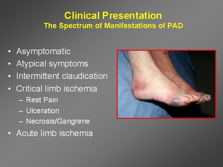 Clinical Presentation The Spectrum of Manifestations of PAD • • Asymptomatic Atypical symptoms Intermittent