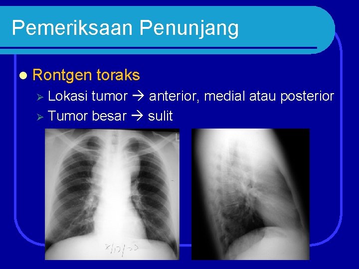 Pemeriksaan Penunjang l Rontgen toraks Lokasi tumor anterior, medial atau posterior Ø Tumor besar