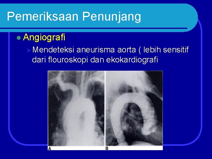 Pemeriksaan Penunjang l Angiografi Ø Mendeteksi aneurisma aorta ( lebih sensitif dari flouroskopi dan