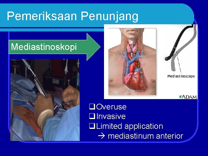 Pemeriksaan Penunjang Mediastinoskopi q. Overuse q. Invasive q. Limited application mediastinum anterior 