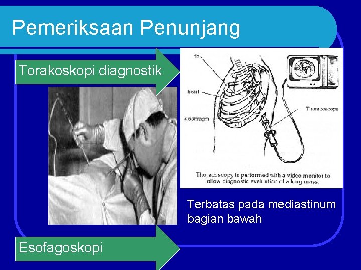 Pemeriksaan Penunjang Torakoskopi diagnostik Terbatas pada mediastinum bagian bawah Esofagoskopi 