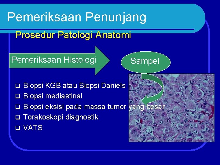 Pemeriksaan Penunjang Prosedur Patologi Anatomi Pemeriksaan Histologi q q q Sampel Biopsi KGB atau