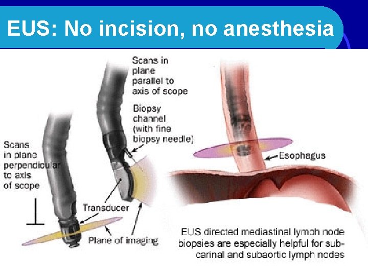 EUS: No incision, no anesthesia 