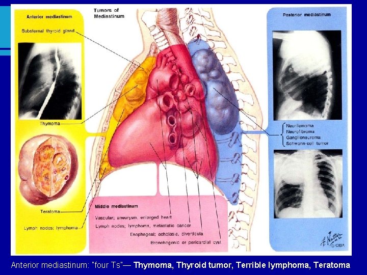 Anterior mediastinum: “four Ts”— Thymoma, Thyroid tumor, Terrible lymphoma, Teratoma 