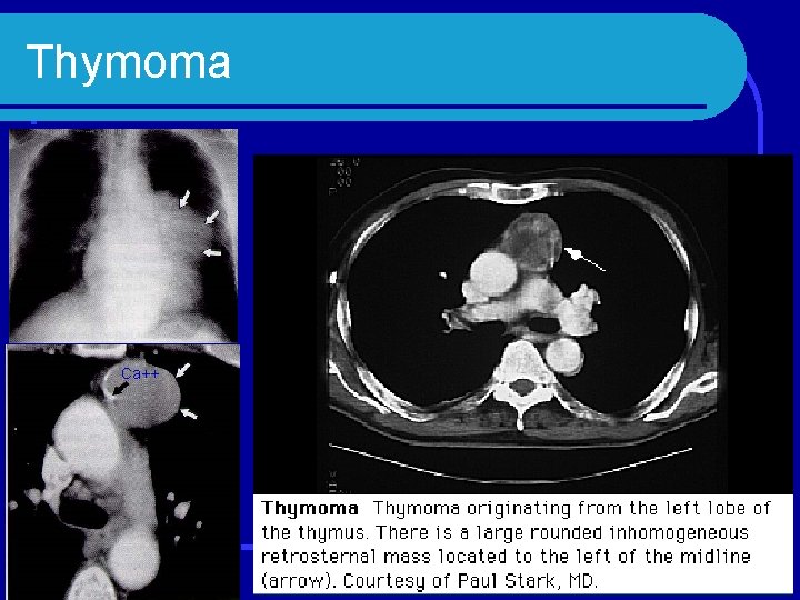 Thymoma Ca++ 
