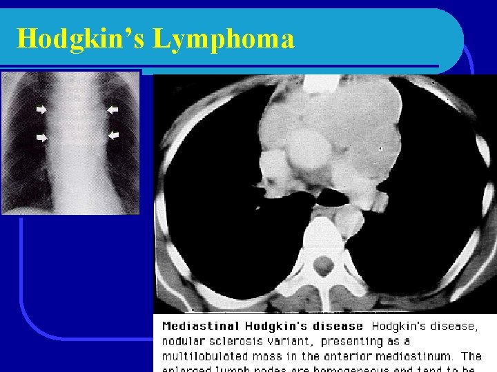 Hodgkin’s Lymphoma 