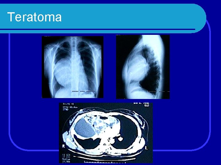 Teratoma 