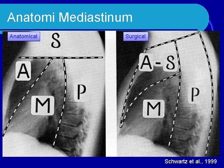 Anatomi Mediastinum Anatomical Surgical Schwartz et al. , 1999 