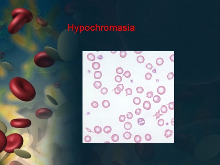 Hypochromasia 