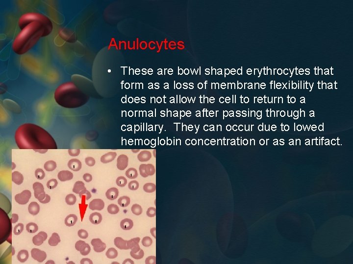 Anulocytes • These are bowl shaped erythrocytes that form as a loss of membrane