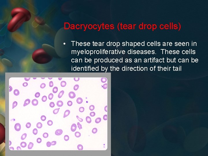Dacryocytes (tear drop cells) • These tear drop shaped cells are seen in myeloproliferative