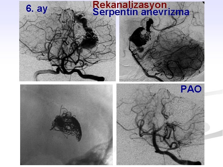 6. ay Rekanalizasyon Serpentin anevrizma PAO 