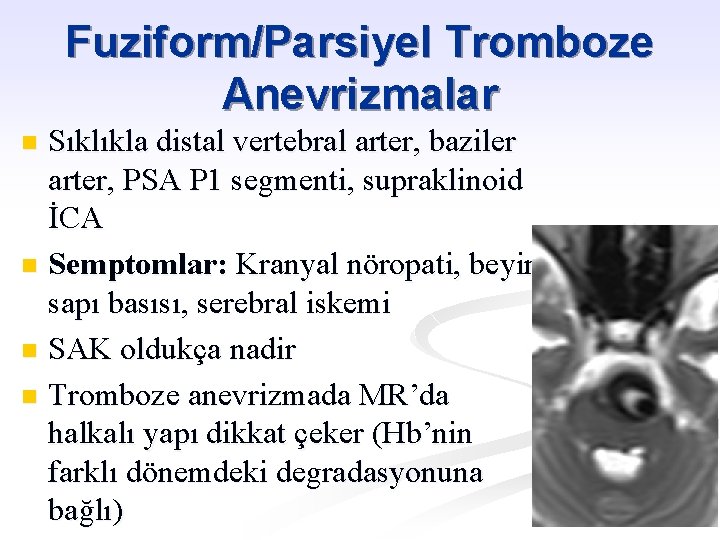 Fuziform/Parsiyel Tromboze Anevrizmalar Sıklıkla distal vertebral arter, baziler arter, PSA P 1 segmenti, supraklinoid