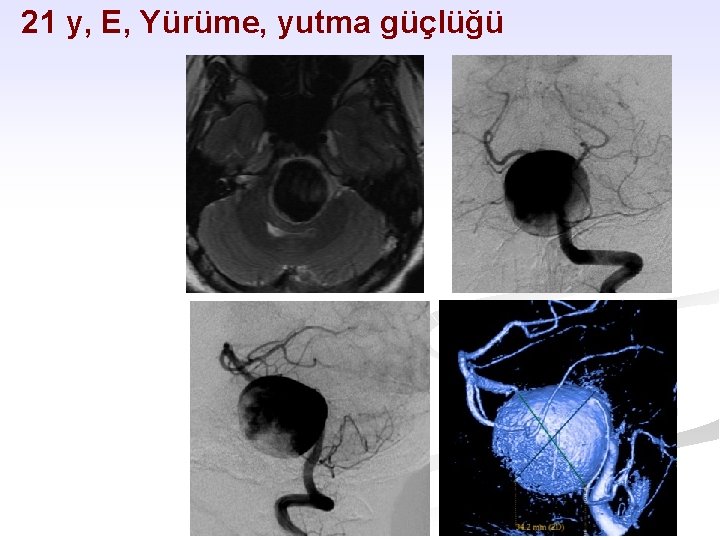 21 y, E, Yürüme, yutma güçlüğü 