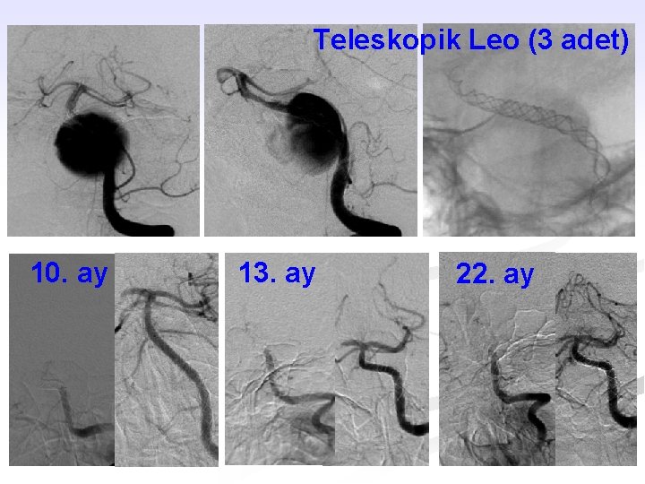 Teleskopik Leo (3 adet) 10. ay 13. ay 22. ay 