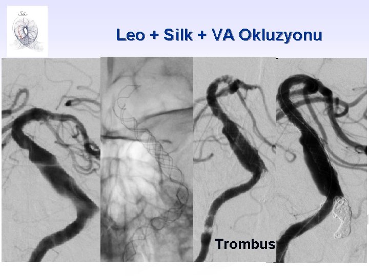 Leo + Silk + VA Okluzyonu Trombus 