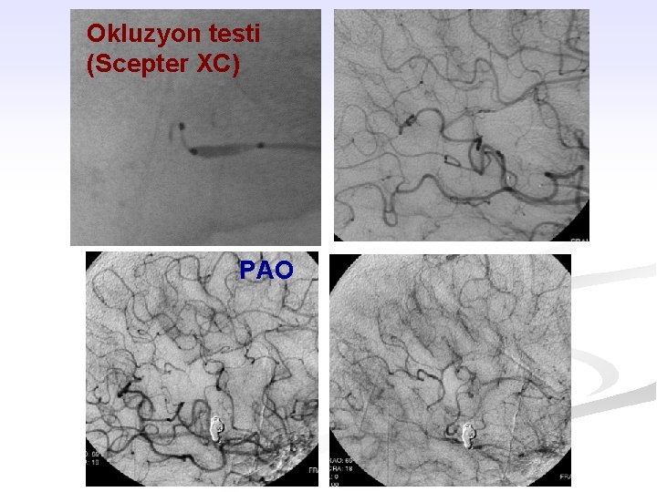 Okluzyon testi (Scepter XC) PAO 
