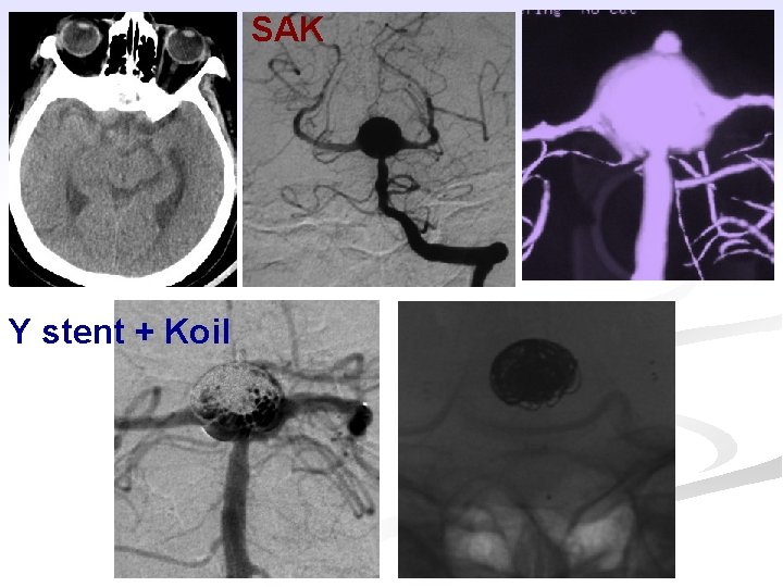 SAK Y stent + Koil 
