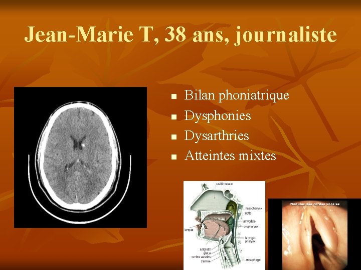 Jean-Marie T, 38 ans, journaliste n n Bilan phoniatrique Dysphonies Dysarthries Atteintes mixtes Jean-Marie T, 38 ans, journaliste n n Bilan phoniatrique Dysphonies Dysarthries Atteintes mixtes