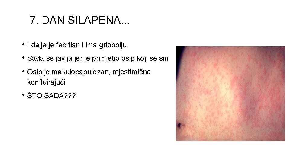 7. DAN SILAPENA. . . • I dalje je febrilan i ima grlobolju •