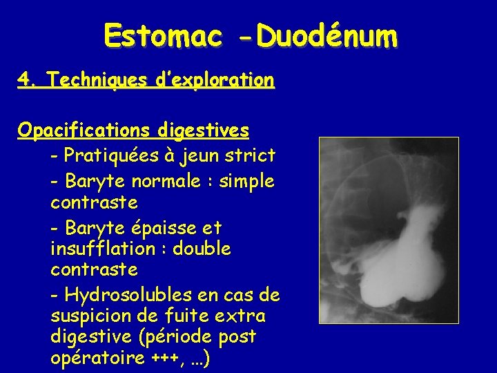 Estomac -Duodénum 4. Techniques d’exploration Opacifications digestives - Pratiquées à jeun strict - Baryte