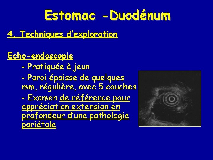 Estomac -Duodénum 4. Techniques d’exploration Echo-endoscopie - Pratiquée à jeun - Paroi épaisse de