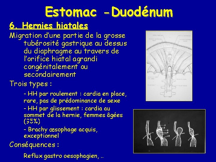 Estomac -Duodénum 6. Hernies hiatales Migration d’une partie de la grosse tubérosité gastrique au