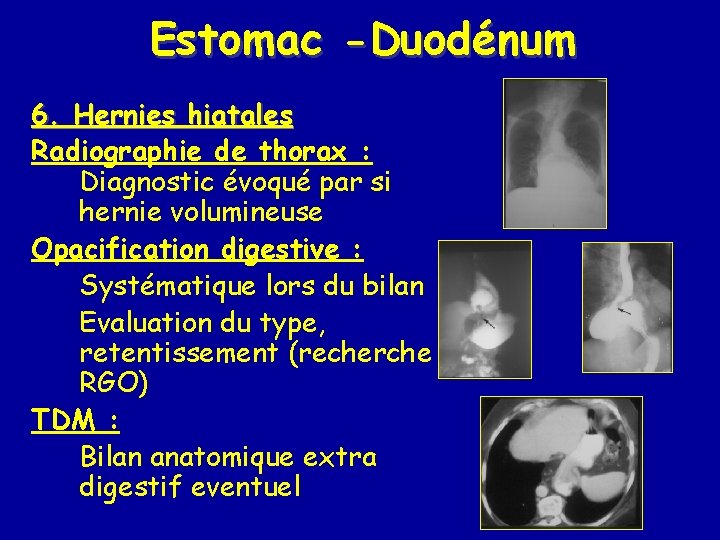 Estomac -Duodénum 6. Hernies hiatales Radiographie de thorax : Diagnostic évoqué par si hernie