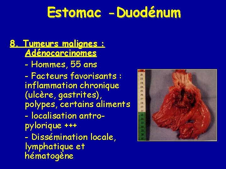 Estomac -Duodénum 8. Tumeurs malignes : Adénocarcinomes - Hommes, 55 ans - Facteurs favorisants