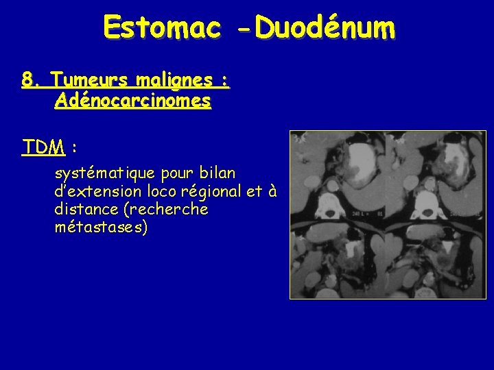 Estomac -Duodénum 8. Tumeurs malignes : Adénocarcinomes TDM : systématique pour bilan d’extension loco