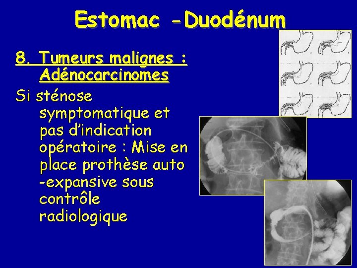 Estomac -Duodénum 8. Tumeurs malignes : Adénocarcinomes Si sténose symptomatique et pas d’indication opératoire