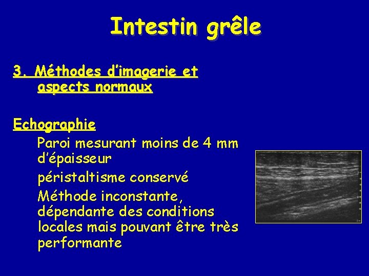 Intestin grêle 3. Méthodes d’imagerie et aspects normaux Echographie Paroi mesurant moins de 4