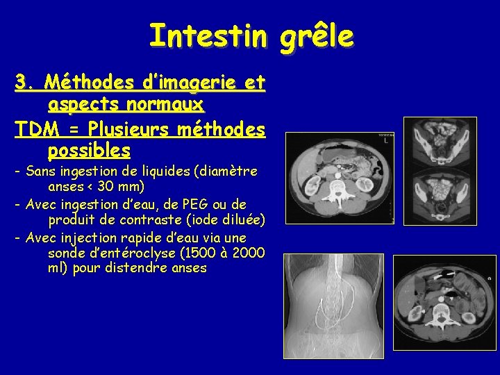 Intestin grêle 3. Méthodes d’imagerie et aspects normaux TDM = Plusieurs méthodes possibles -