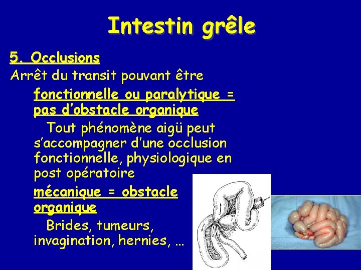 Intestin grêle 5. Occlusions Arrêt du transit pouvant être fonctionnelle ou paralytique = pas