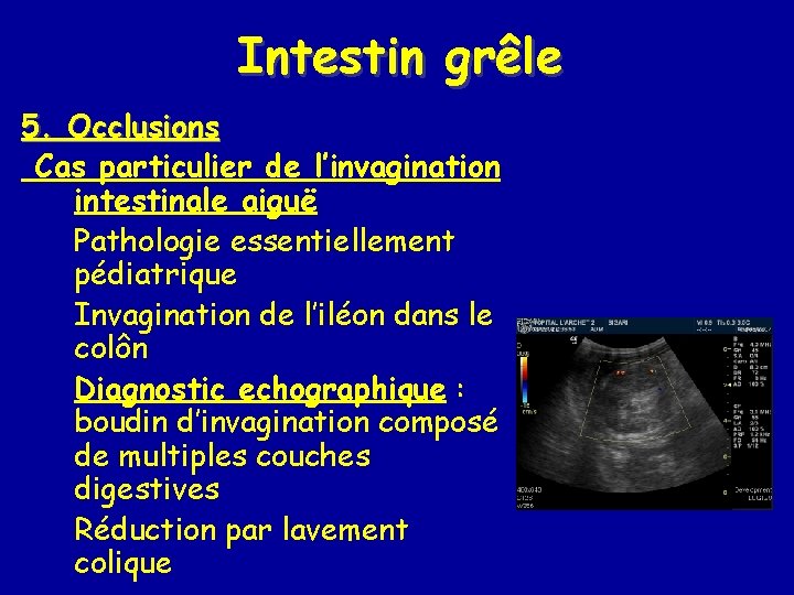 Intestin grêle 5. Occlusions Cas particulier de l’invagination intestinale aiguë Pathologie essentiellement pédiatrique Invagination