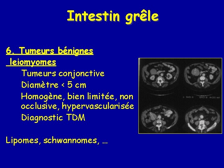 Intestin grêle 6. Tumeurs bénignes leiomyomes Tumeurs conjonctive Diamètre < 5 cm Homogène, bien