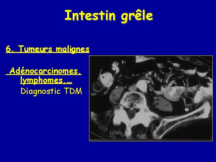 Intestin grêle 6. Tumeurs malignes Adénocarcinomes, lymphomes, … Diagnostic TDM 