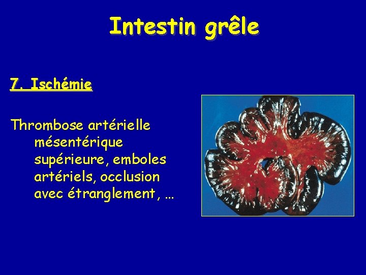 Intestin grêle 7. Ischémie Thrombose artérielle mésentérique supérieure, emboles artériels, occlusion avec étranglement, …