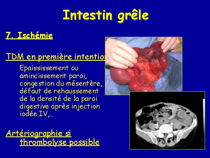 Intestin grêle 7. Ischémie TDM en première intention Epaississement ou amincissement paroi, congestion du